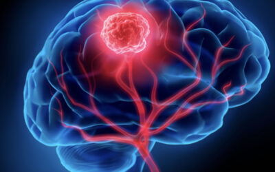 Tumores cerebrales