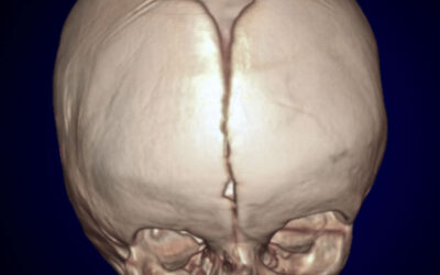 Craneosinostosis