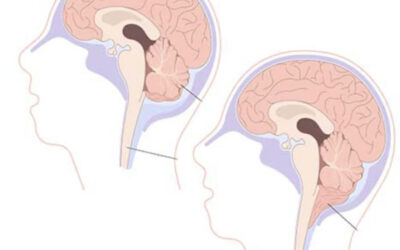 Malformación de Chiari